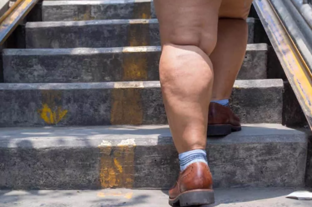 lipedema2-1.png